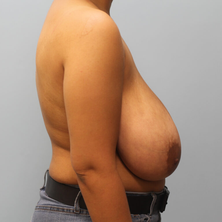 Before Image: Breast Reduction-Dr.Howell - left-side