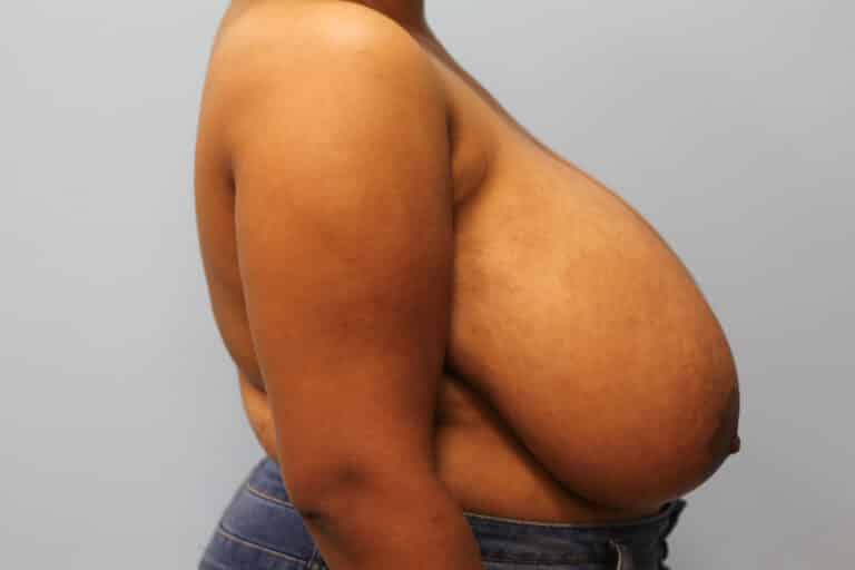 Before Image: Breast Reduction – Dr. Howell - right-side