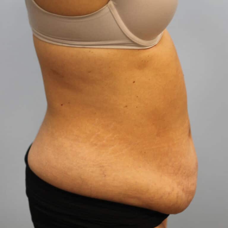 Before Image: Abdominoplasty – Dr. Tucker - right-side