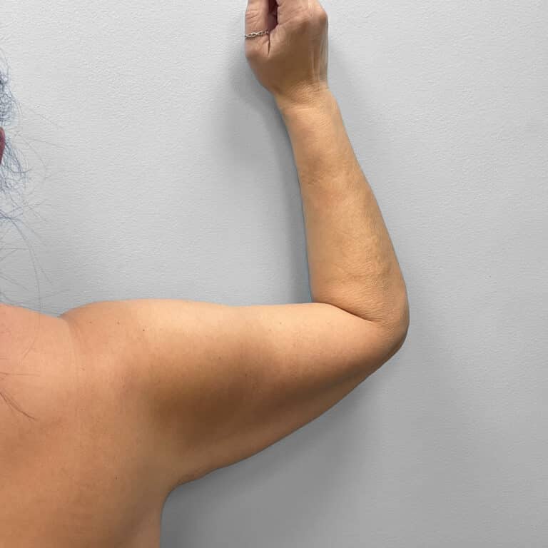 Before Image: Mommy Makeover – Dr. Tucker - right-side