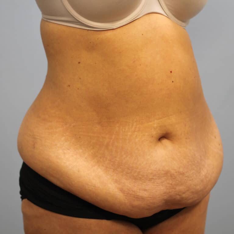 Before Image: Abdominoplasty – Dr. Tucker - right-front-oblique