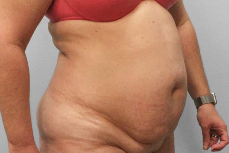 Before Image: Abdominoplasty (Tummy Tuck) – Dr. Tucker - right-front-oblique
