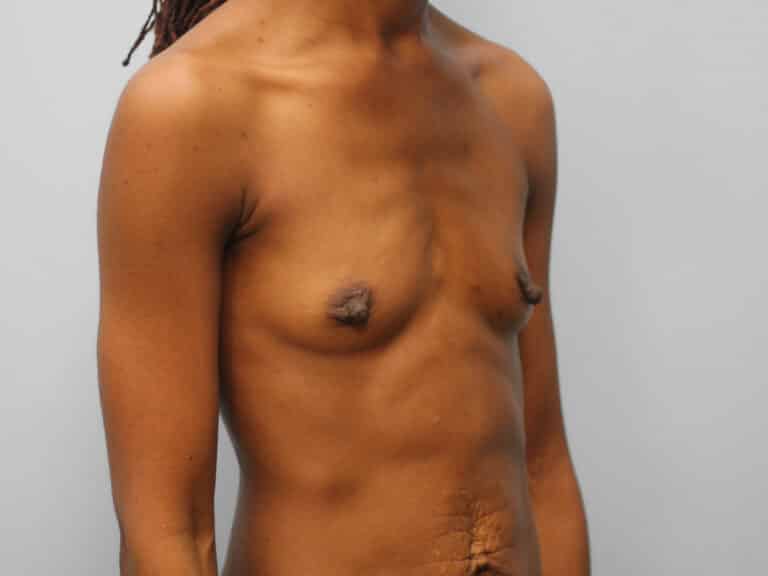 Before Image: Breast Augmentation – Dr. Tucker - right-front-oblique