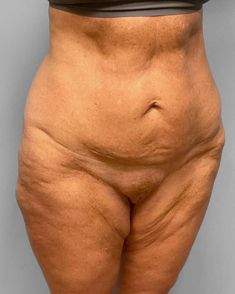 Before Image: Abdominoplasty & Thigh Lift – Dr. Tucker - right-front-oblique
