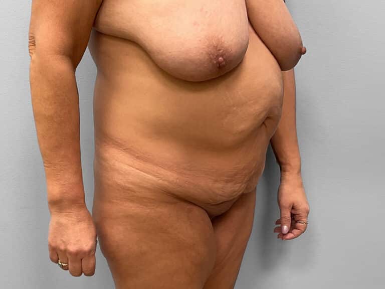 Before Image: Mommy Makeover – Dr. Tucker -