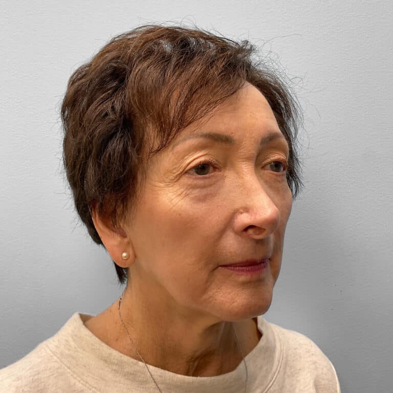 Before Image: Blepharoplasty – Dr. Tucker - right-front-oblique