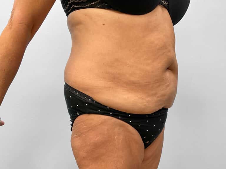 Before Image: Tummy Tuck – Dr. Tucker - right-front-oblique