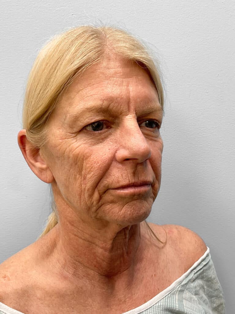 Before Image: Facelift, Blepharoplasty, & TFX – Dr. Tucker - right-front-oblique