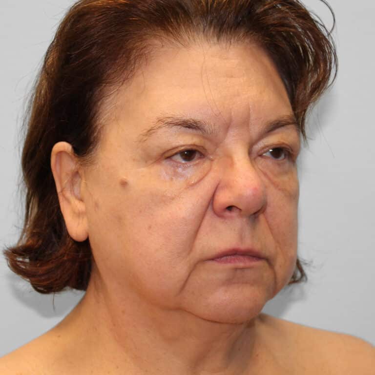 Before Image: Facelift & Blepharoplasty – Dr. Tucker - right-front-oblique