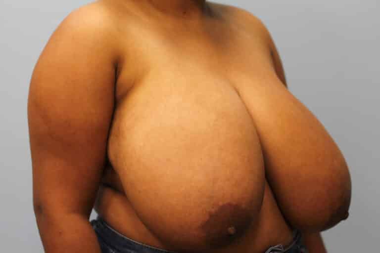 Before Image: Breast Reduction – Dr. Howell - right-front-oblique