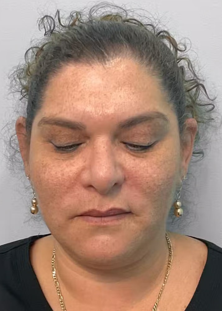Before Image: Kybella- Joy - front