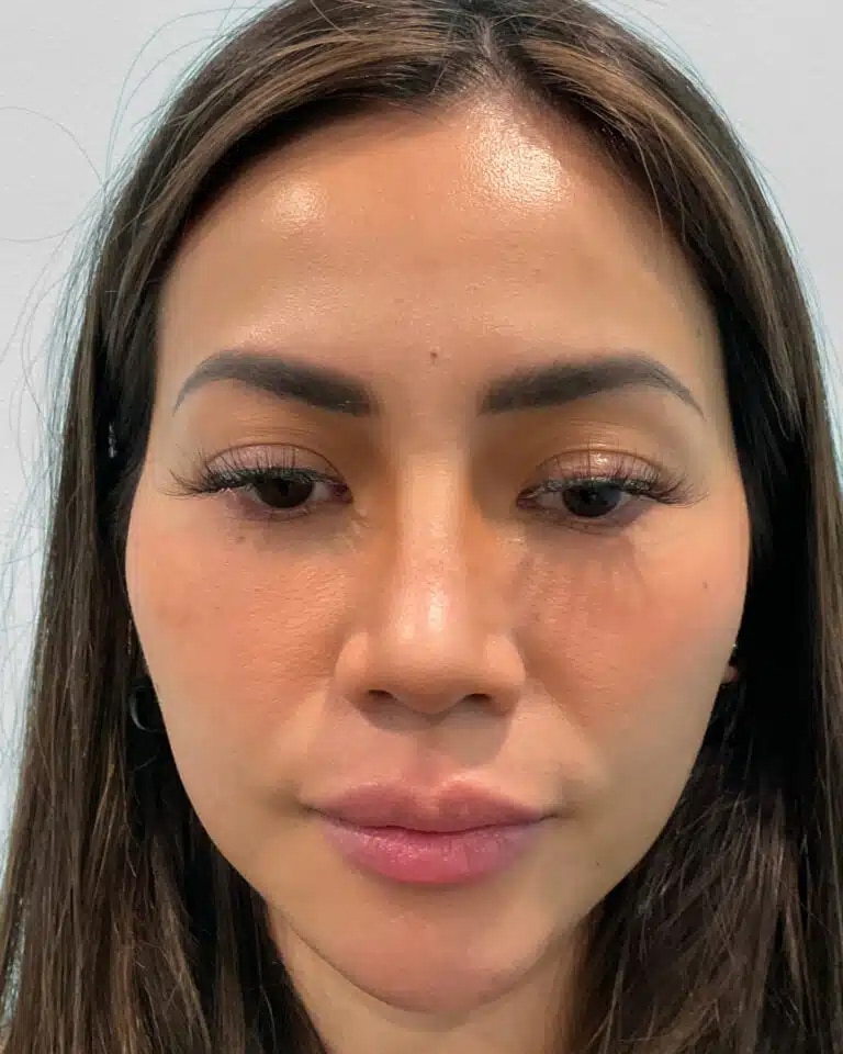 After Image: Juvéderm Volbella & Botox – Heather - front