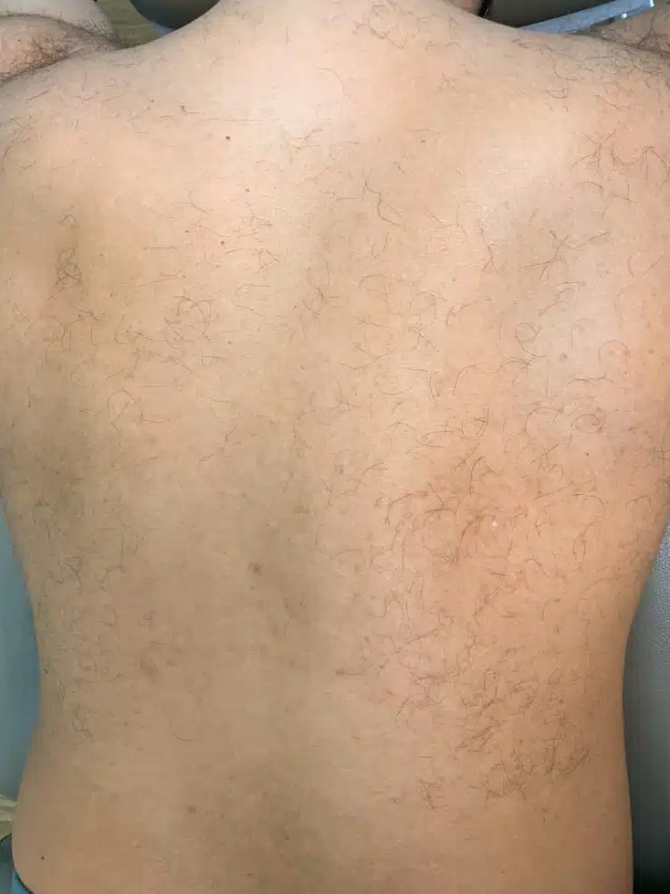 Before Image: Laser Hair Removal- Jade - back