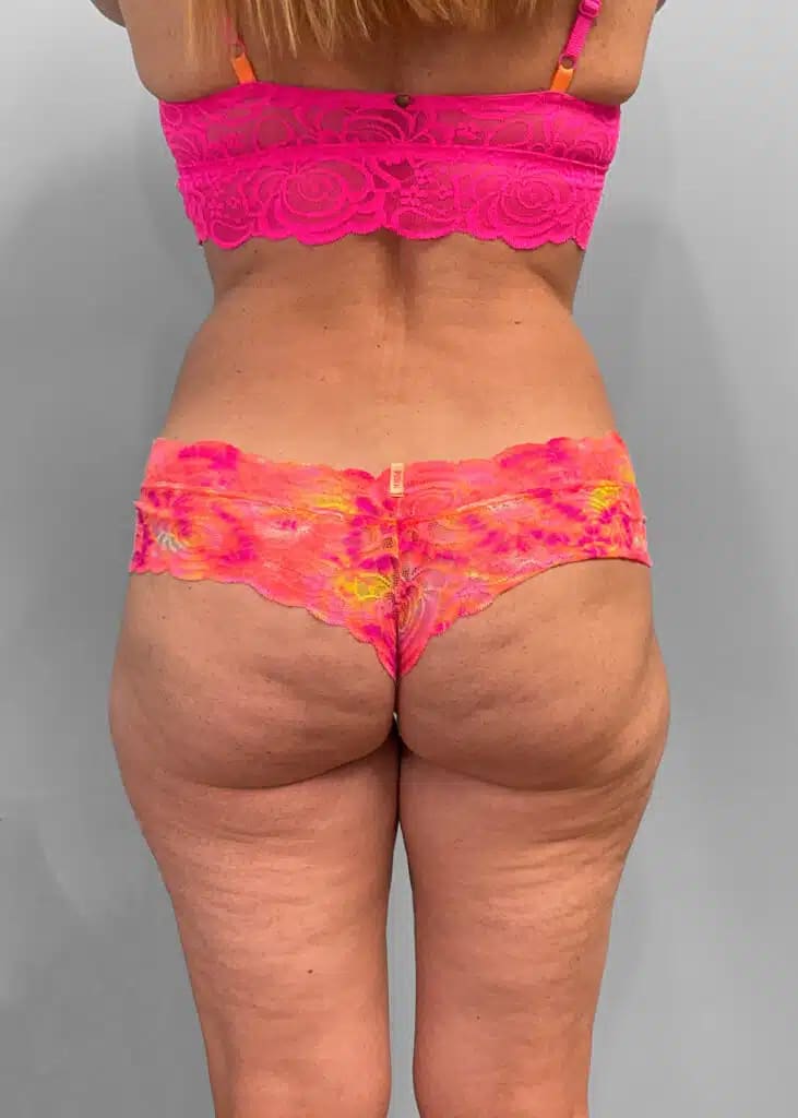 Before Image: Emsculpt Neo- Jessica - back