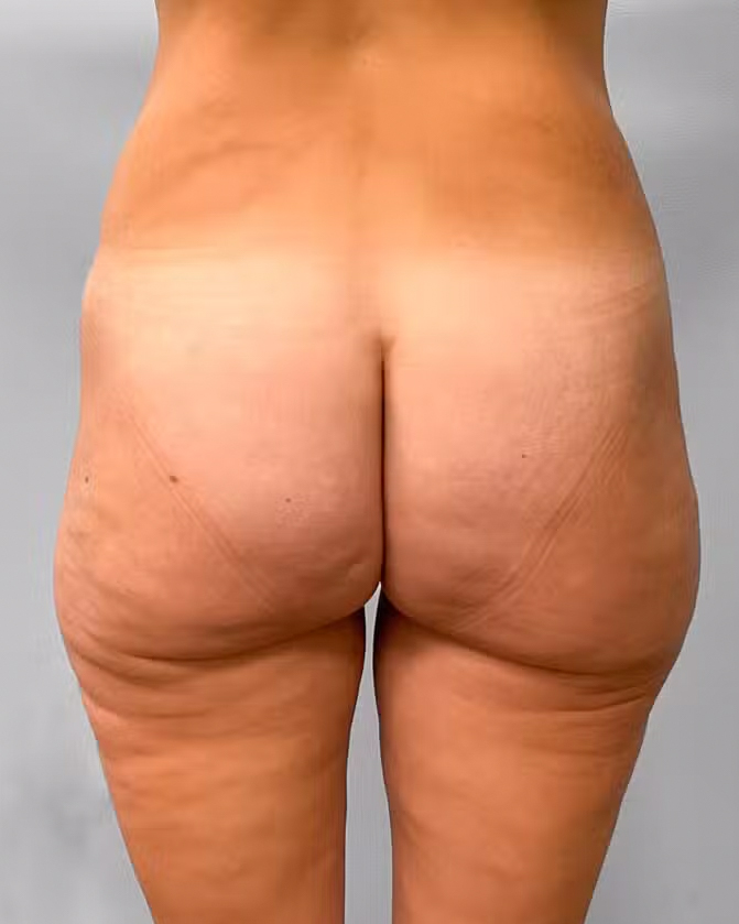 Before Image: Butt Lift- Dr. Howell - front