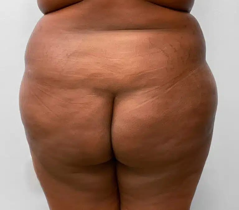 Before Image: BBL Fat Transfer- Dr. Tucker - back