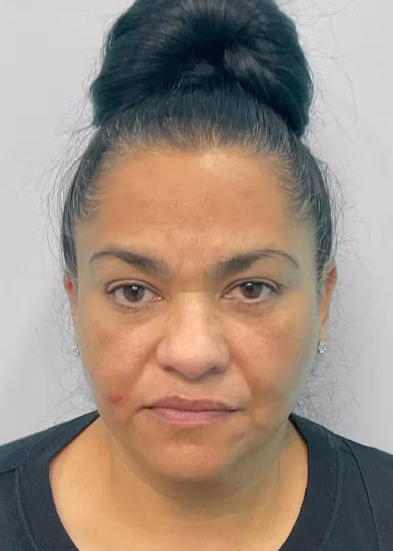Before Image: Botox & Juvéderm- Joy - front