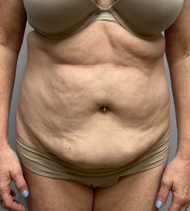 Before Image: Abdominoplasty & Lipo – Dr.Howell - front