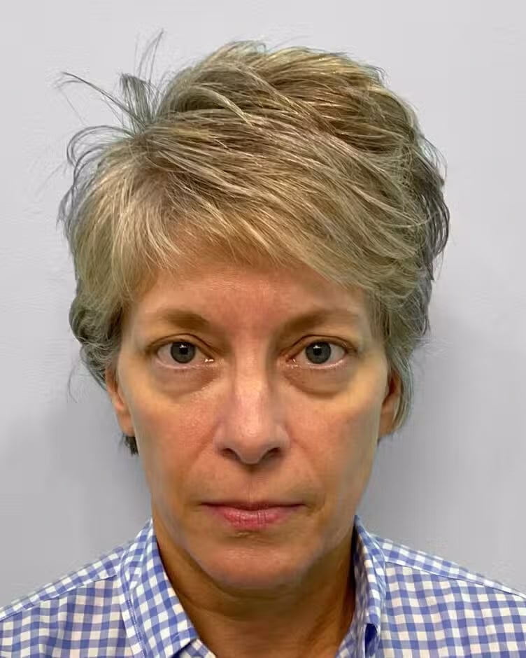 Before Image: Juvéderm Voluma – Joy - front