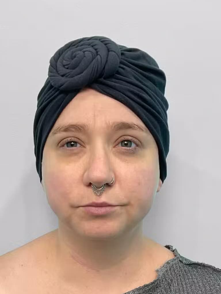 Before Image: Restylane Kysse – Joy - front