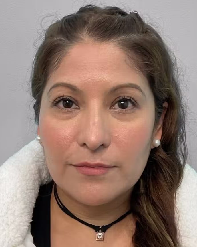 Before Image: Juvéderm Voluma- Joy - front