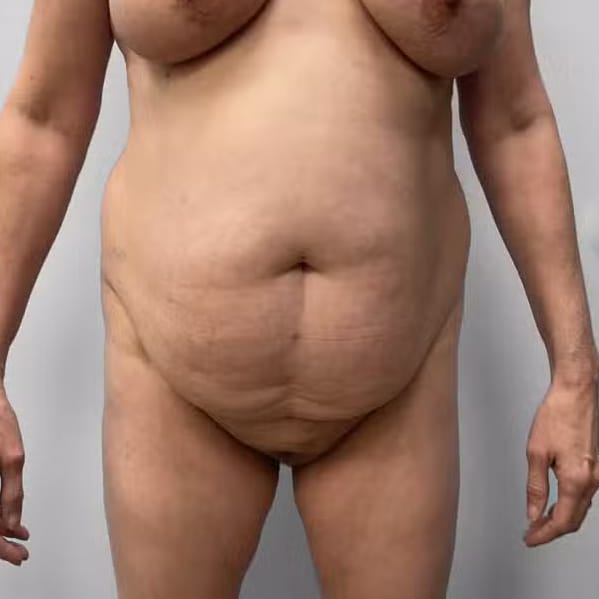 Before Image: Tummy Tuck, Lipo, & BBL – Dr. Tucker - front