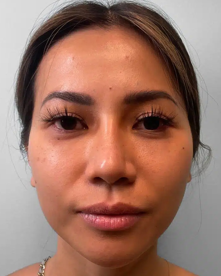 Before Image: Juvéderm Volbella & Botox – Heather - front