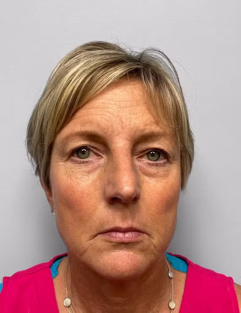 Before Image: Blepharoplasty & Laser Resurfacing- Dr. Howell - front