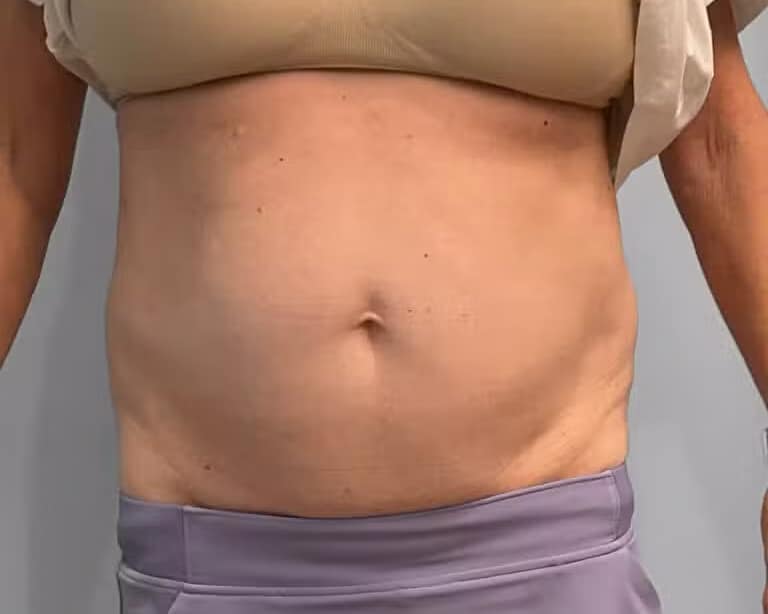 Before Image: Emsculpt Neo- Jessica - front