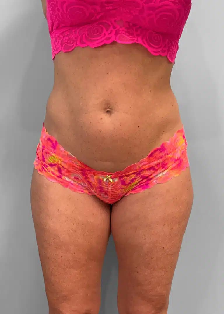 Before Image: Emsculpt Neo- Jessica - front