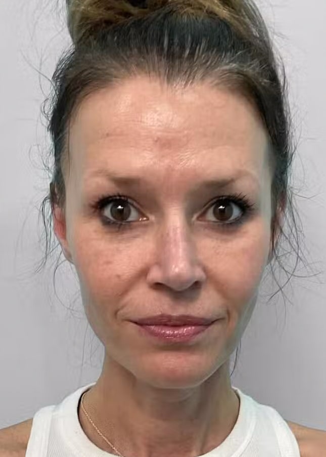 Before Image: Juvéderm Vollure & Botox – Joy - front