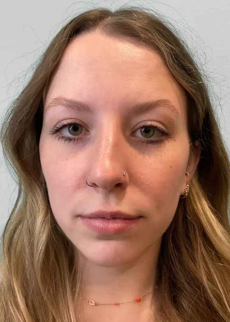 Before Image: Juvéderm Ultra – Heather - front