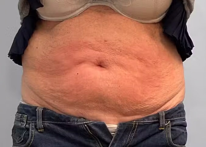 Before Image: Emsculpt Neo- Jessica - front