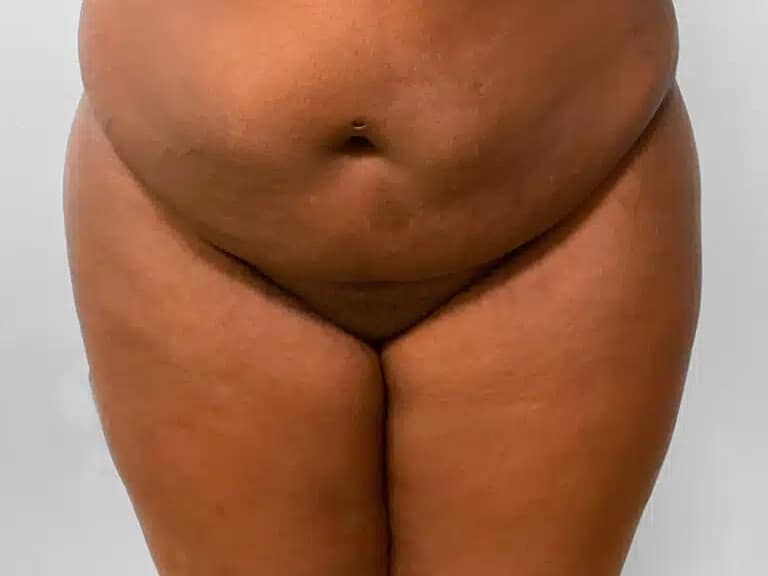 Before Image: BBL Fat Transfer- Dr. Tucker - front
