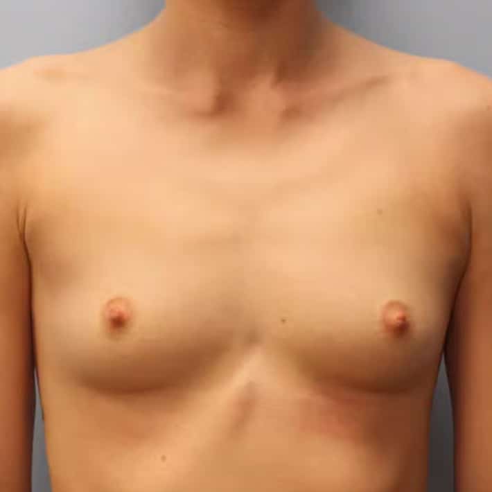 Before Image: Breast Augmentation – Dr. Howell - front