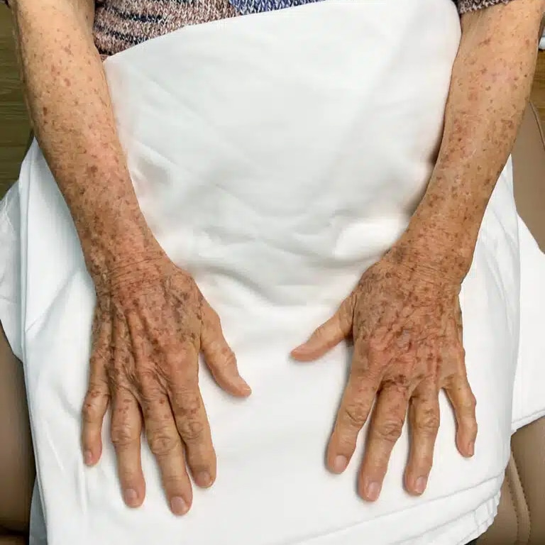 Before Image: Laser Treatment- Jade - front