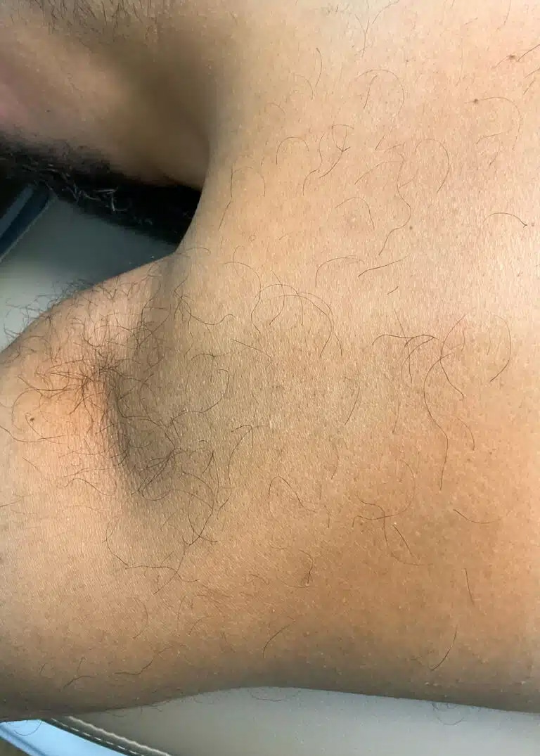 Before Image: Laser Hair Removal- Jade - left-side