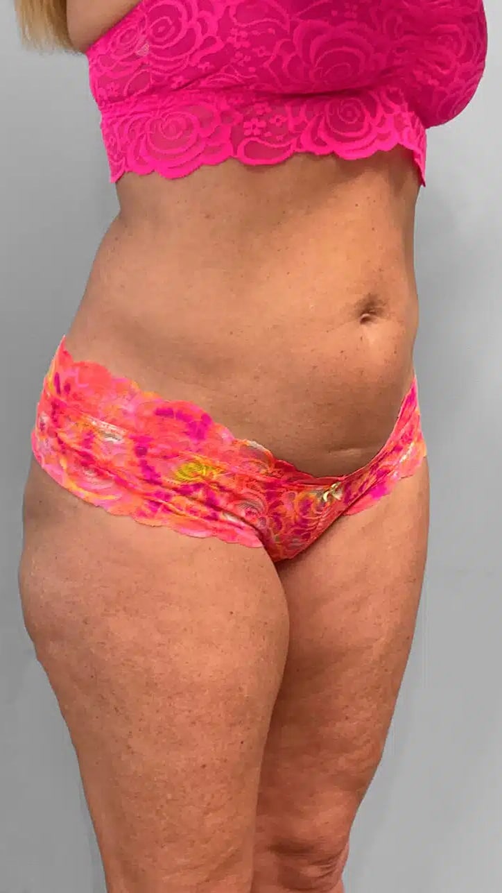 Before Image: Emsculpt Neo- Jessica - right-front-oblique