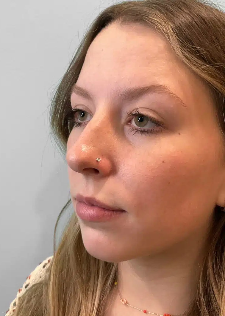 Before Image: Juvéderm Ultra – Heather - left-front-oblique