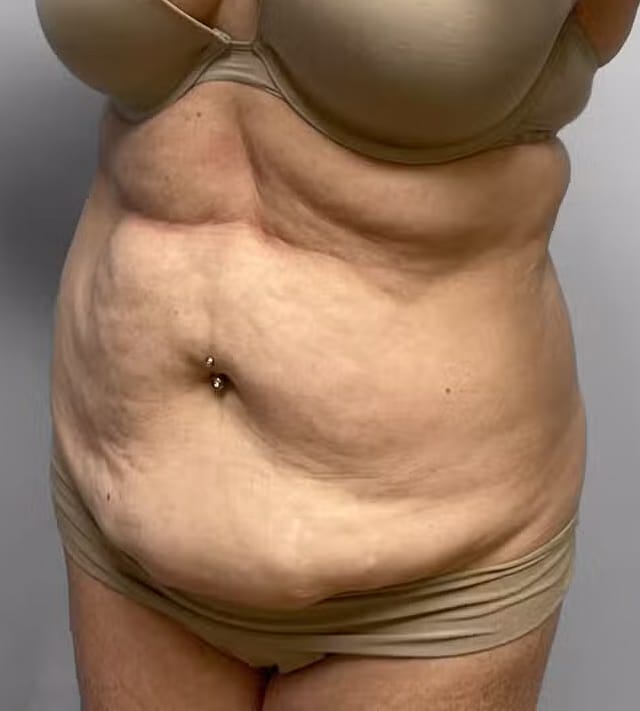 Before Image: Abdominoplasty & Lipo – Dr.Howell - left-front-oblique