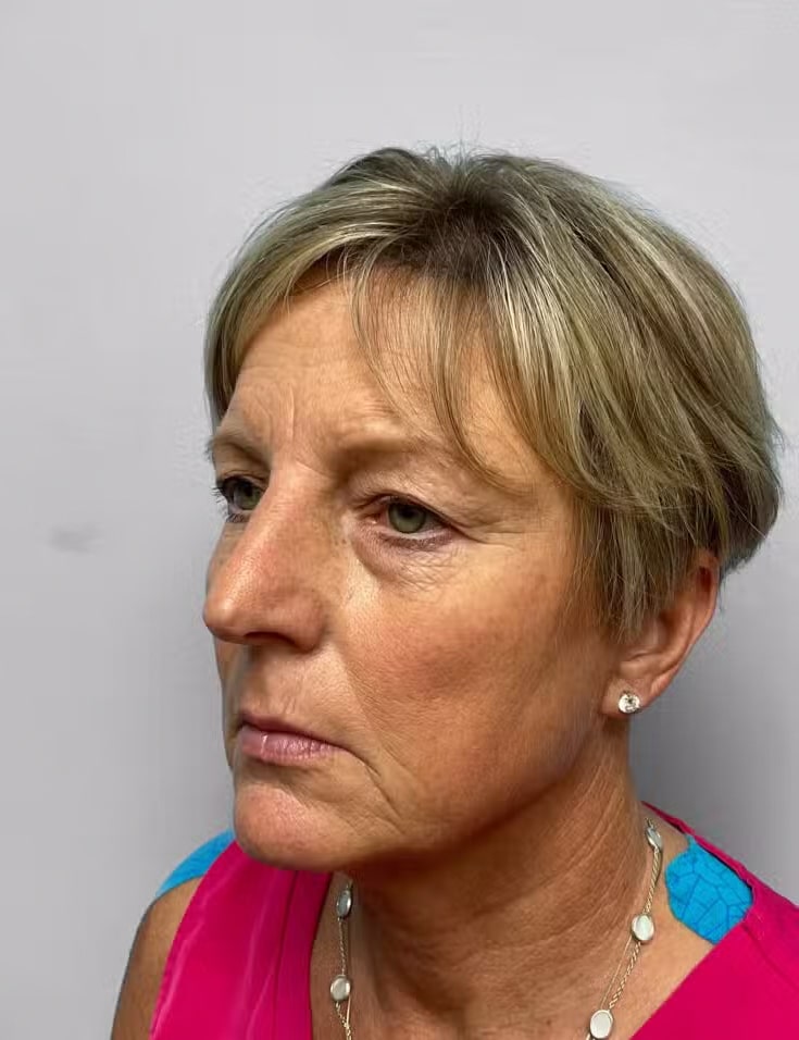Before Image: Blepharoplasty & Laser Resurfacing- Dr. Howell - left-front-oblique