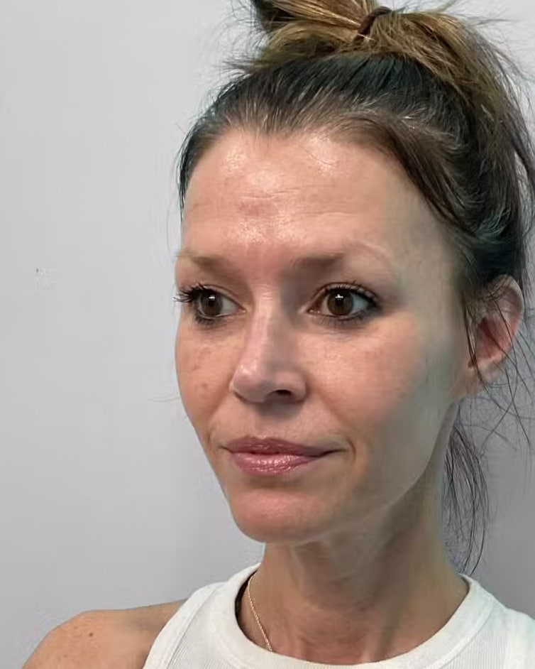 Before Image: Juvéderm Vollure & Botox – Joy - left-front-oblique