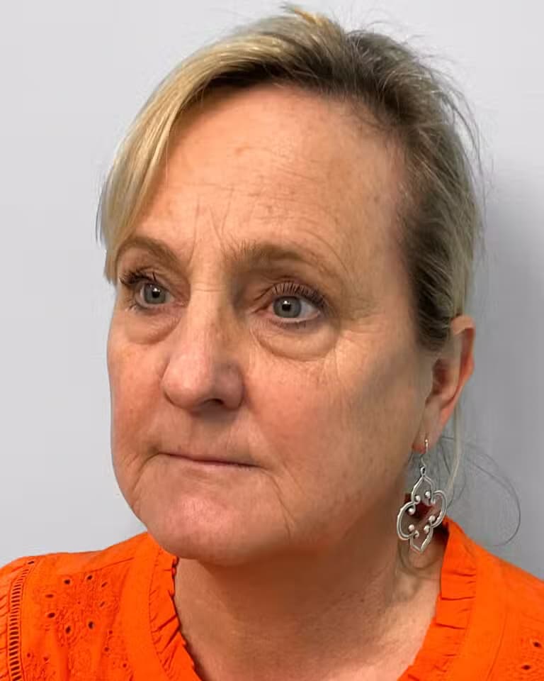 Before Image: Juvéderm Voluma- Joy - left-front-oblique