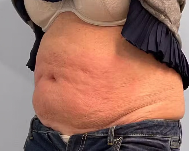 Before Image: Emsculpt Neo- Jessica - left-front-oblique