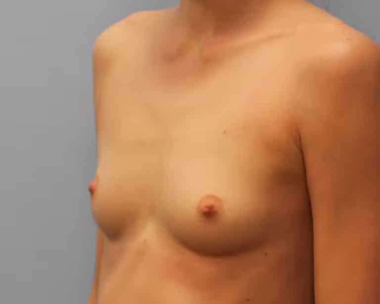Before Image: Breast Augmentation – Dr. Howell - left-front-oblique