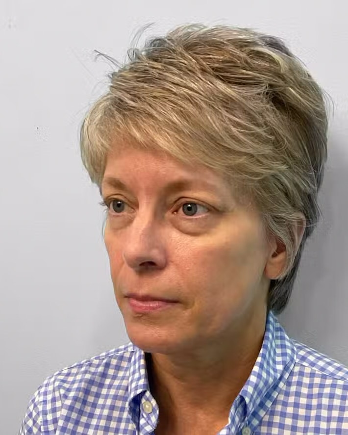 Before Image: Juvéderm Voluma – Joy - left-front-oblique