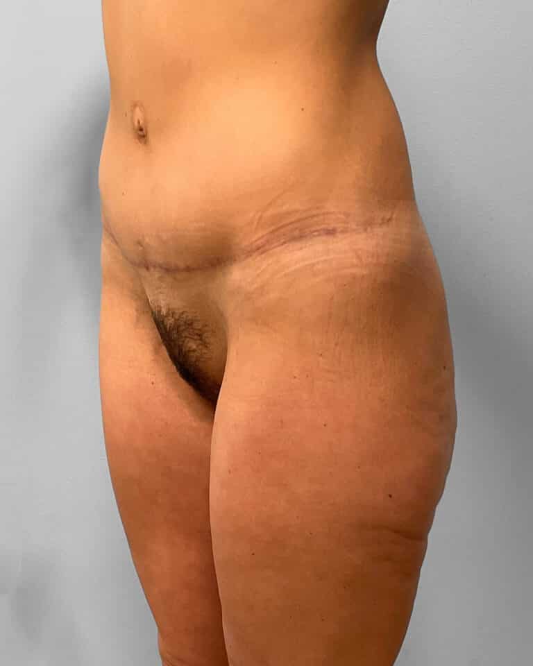 Before Image: Butt Lift- Dr. Howell - left-front-oblique