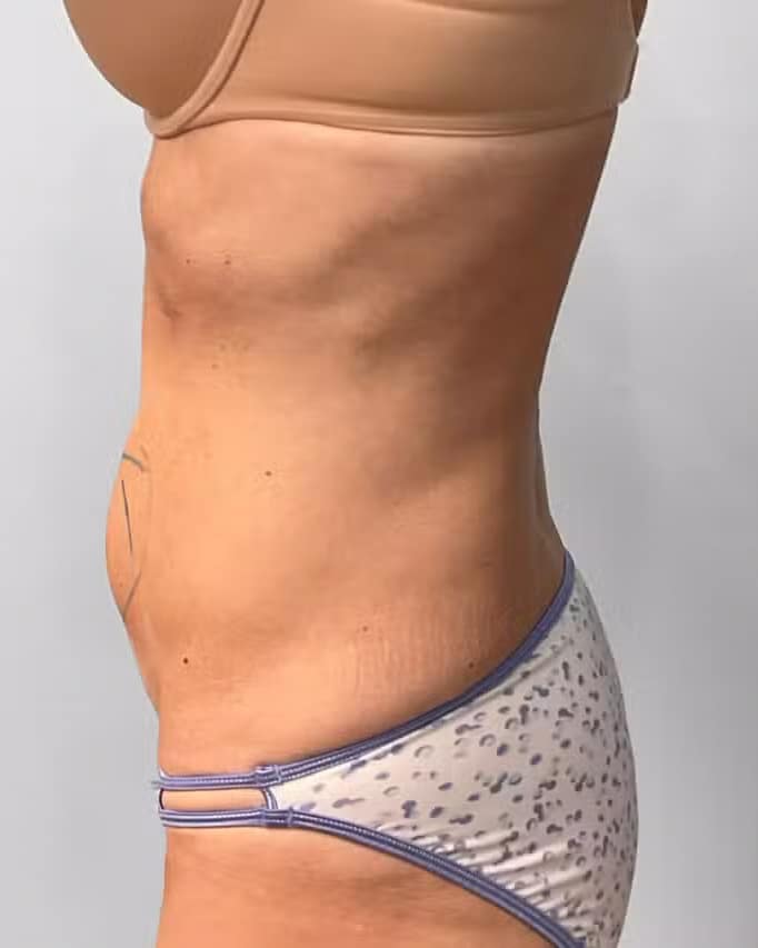 Before Image: Coolsculpting- Jessica - left-side