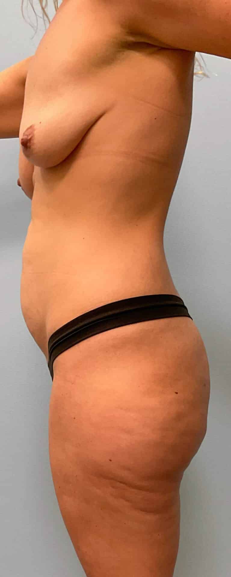 Before Image: Mommy Makeover- Dr. Howell - left-side