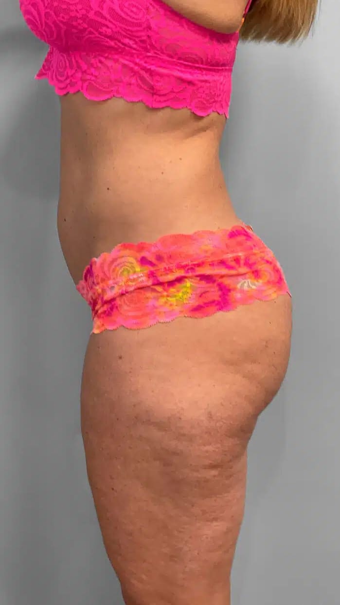 Before Image: Emsculpt Neo- Jessica - left-side
